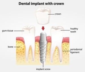 Dental Implants at Reston Smilezone