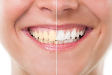 teeth whitening in reston va